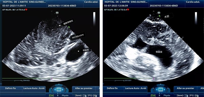 左圖顯示術(shù)中超聲見囊實性病變，大小約為4x4x3cm，病灶周圍腦組織水腫明顯；右圖為病灶切除后，術(shù)中超聲示術(shù)腔無病變殘留