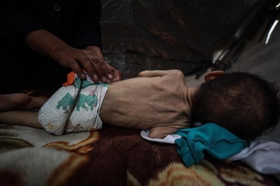 這是5月28日在加沙城西部一處臨時(shí)安置點(diǎn)拍攝的一名營(yíng)養(yǎng)不良的嬰兒。新華社發(fā)（馬哈茂德·扎基攝）
